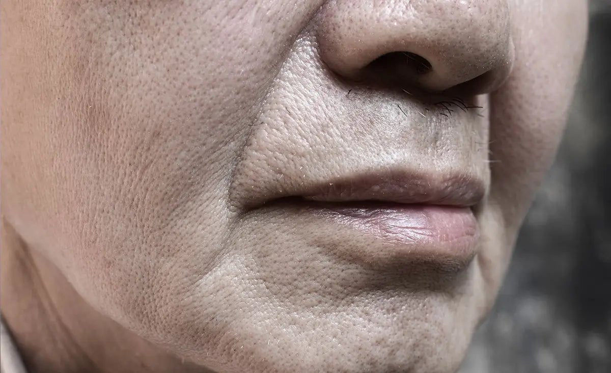 Understanding Nasolabial Folds and How to Minimize Their Appearance - AgeDefy Labs™